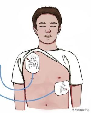 3000字解读张志杰星陨细节，对手哀悼视频曝光，科普AED的重要性  第15张